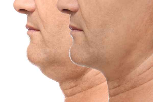 HIFU - Breakthrough in Anti - ageing 2 hifu results Cambridge