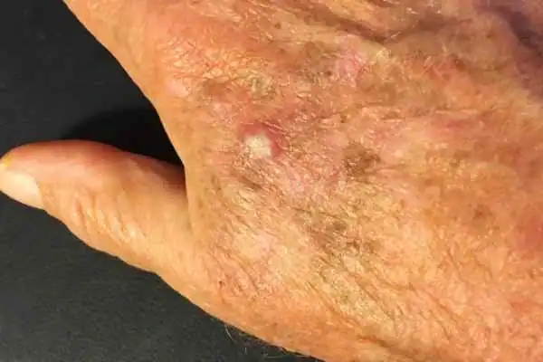 Image of Actinic keratoses Cambridge on a person hand